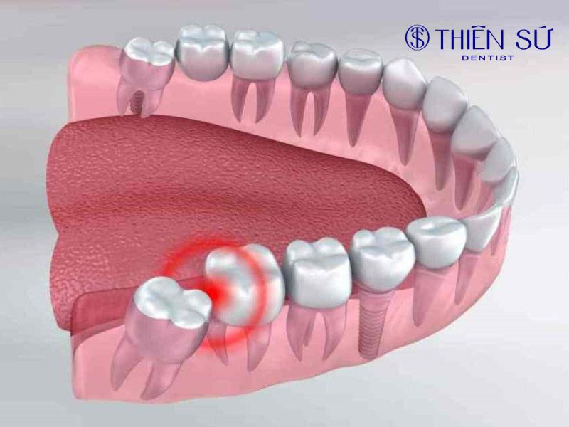 mọc răng khôn bị sưng má phải làm sao